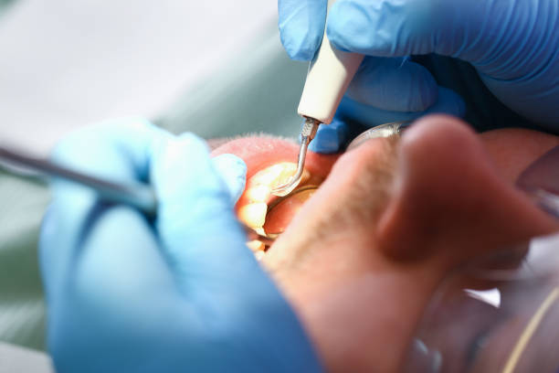 Best Emergency Tooth Extraction in Eaton, IN